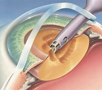 Cataract Surgery Là Gì